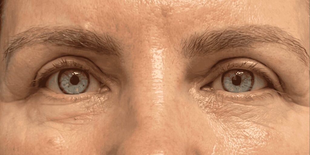 Upper Eyelid Surgery — after