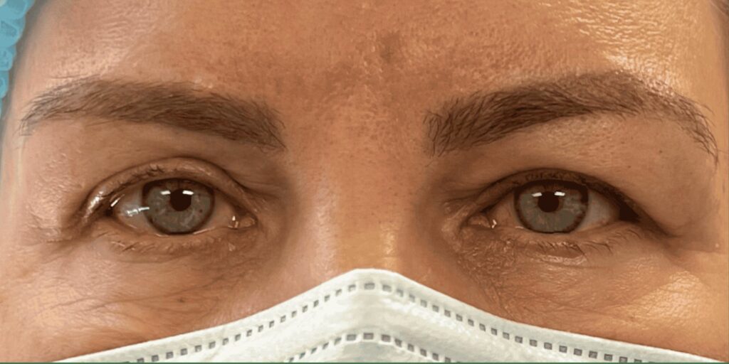 Upper Eyelid Surgery — before