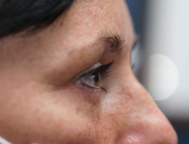 Lower Eyelid Surgery — after