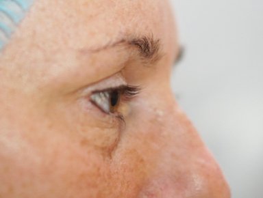 Lower Eyelid Surgery — before