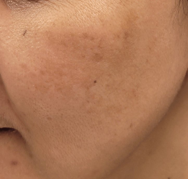 Fractional Laser Resurfacing — after