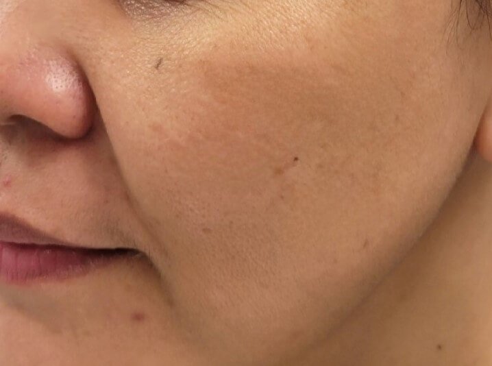 Fractional Laser Resurfacing — before