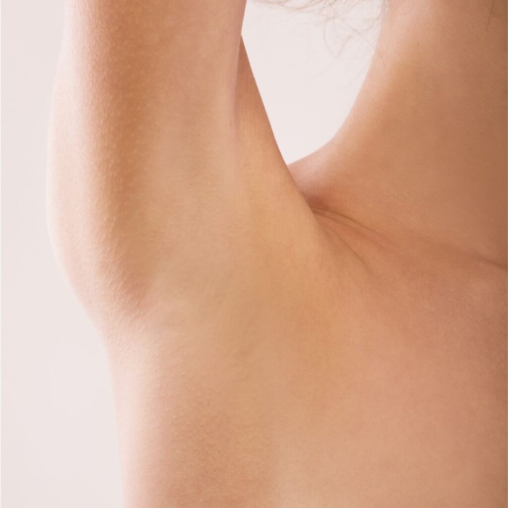 Laser Hair Removal — after