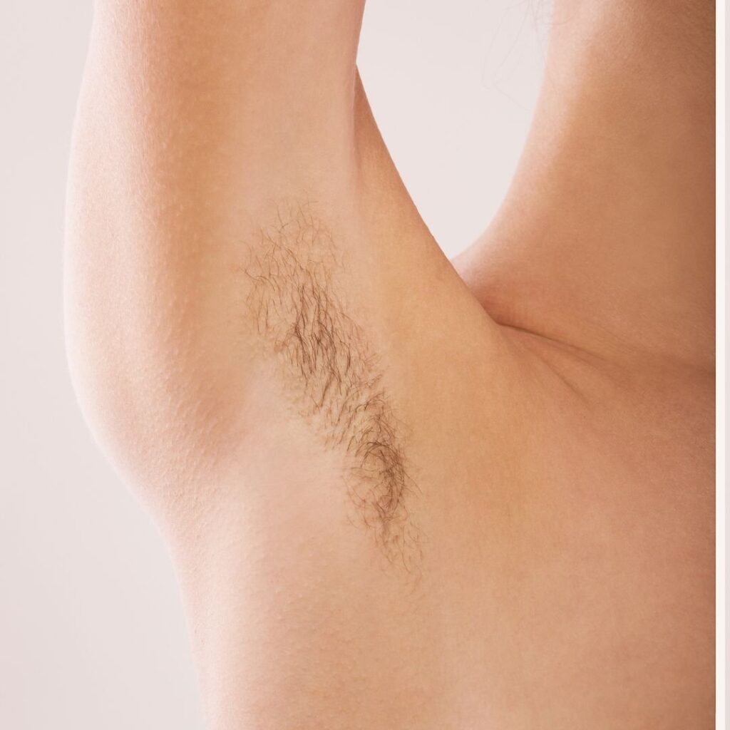 Laser Hair Removal — before