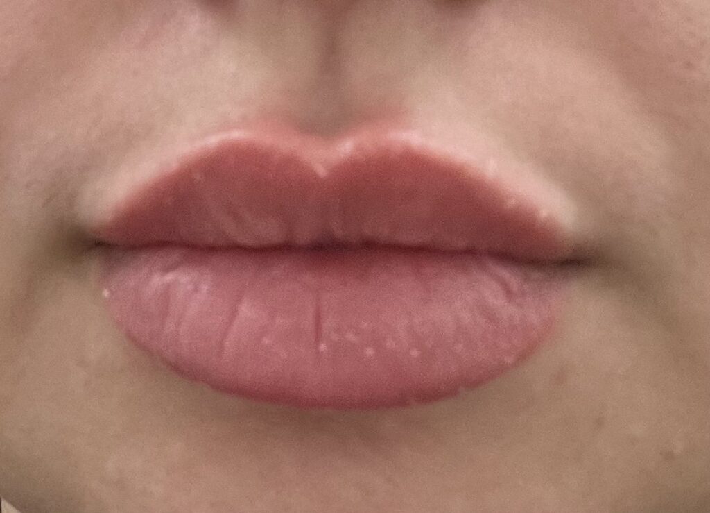 LipLase™ — after