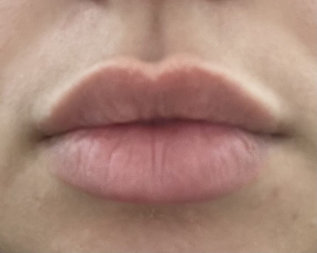 LipLase™ — before