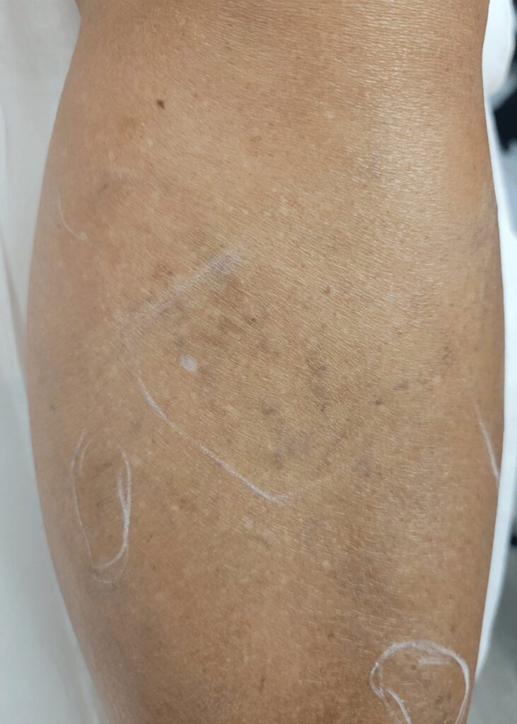 Leg Vein Treatment — after