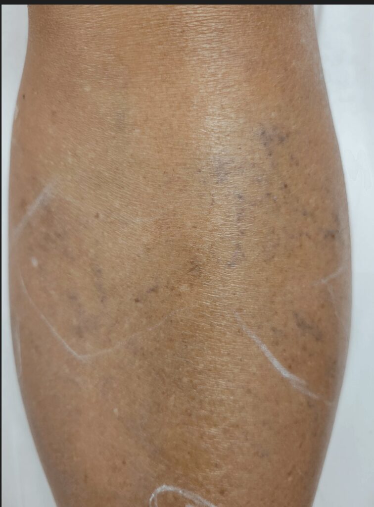 Leg Vein Treatment — before