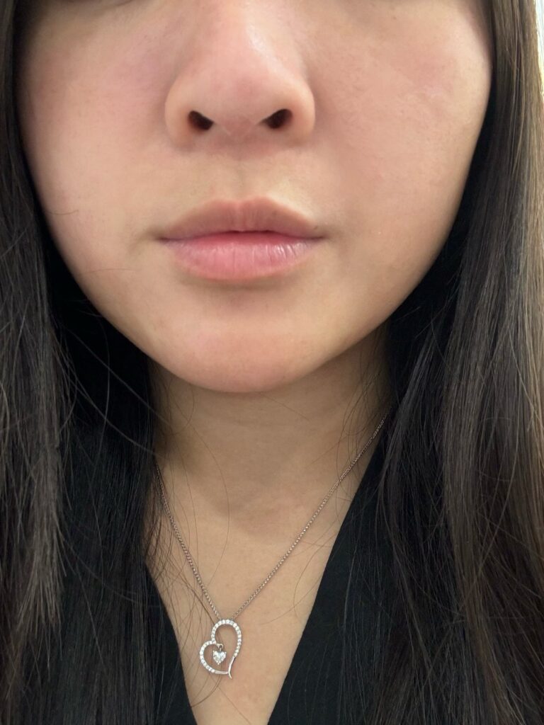 Micro Laser Peel — after