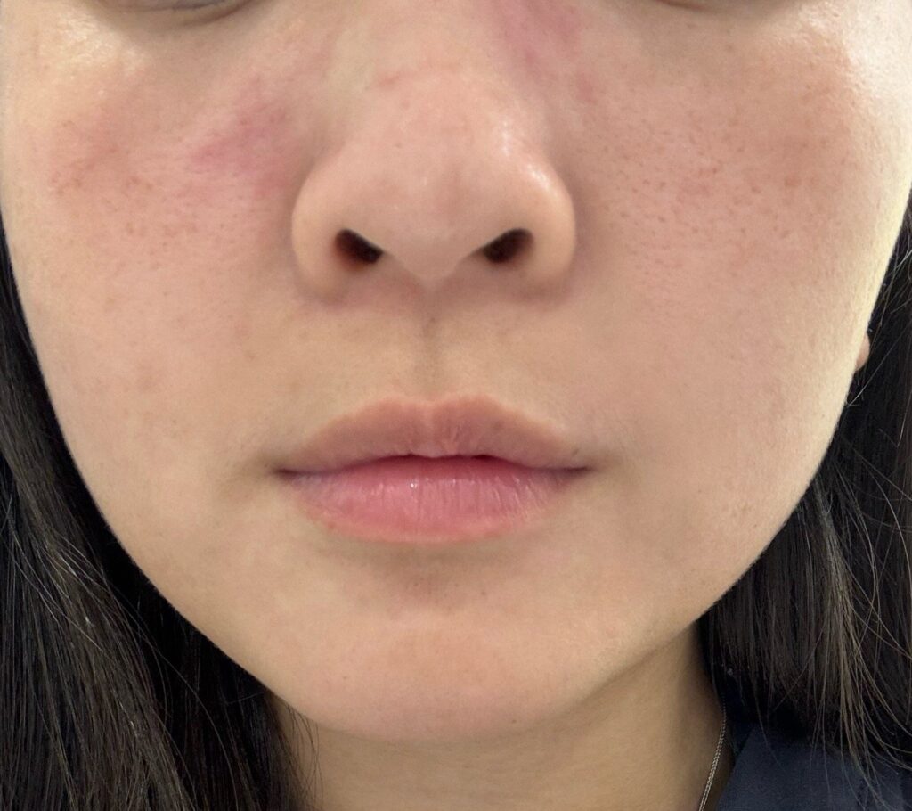 Micro Laser Peel — before