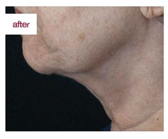 360 Neck Lift — after