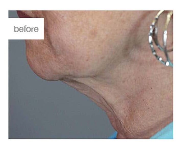 360 Neck Lift — before