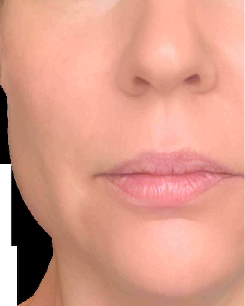 U-Plasma · Microneedling + PRP — after