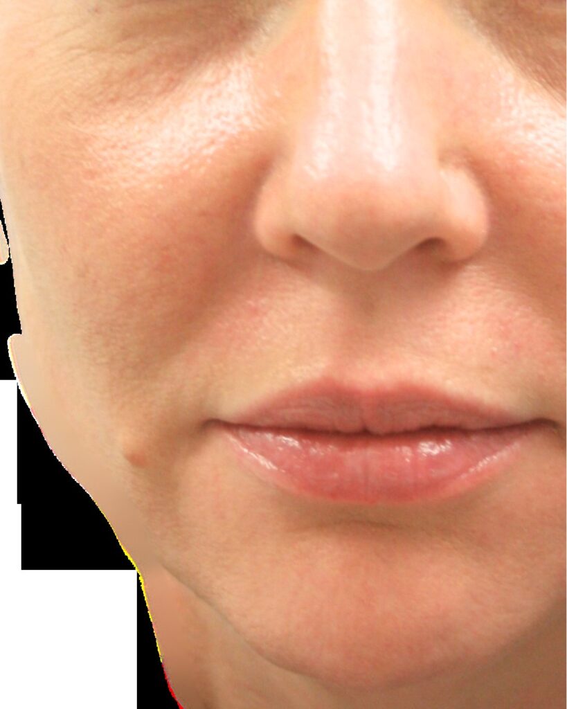 U-Plasma · Microneedling + PRP — before