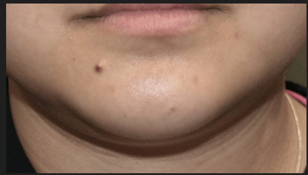 Rosacea Treatment — after