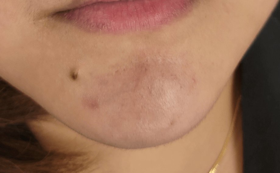 Rosacea Treatment — before