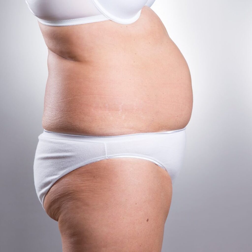 TightSculpting™ — before