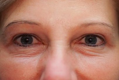 Upper Eyelid Surgery — after