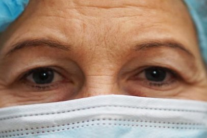 Upper Eyelid Surgery — before