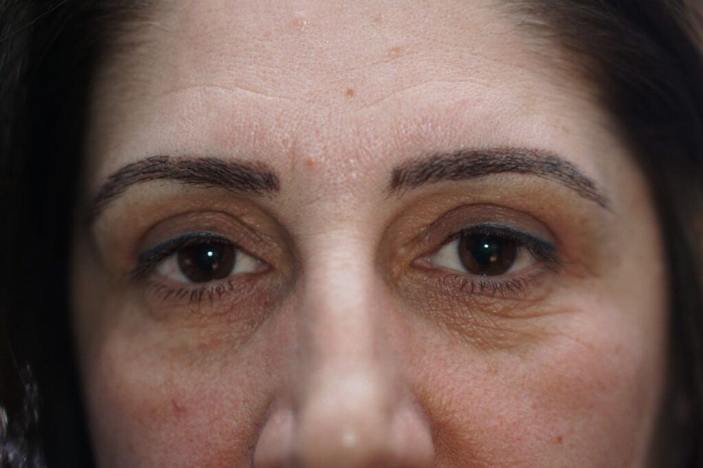 Lower Eyelid Surgery — after