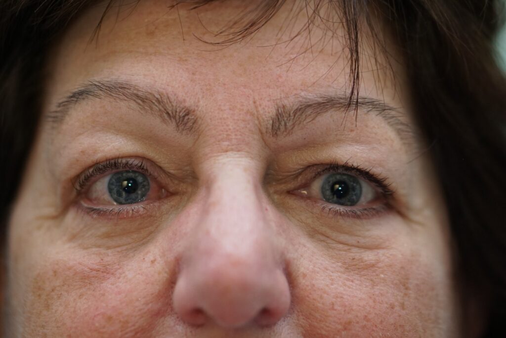 Lower Eyelid Surgery — after