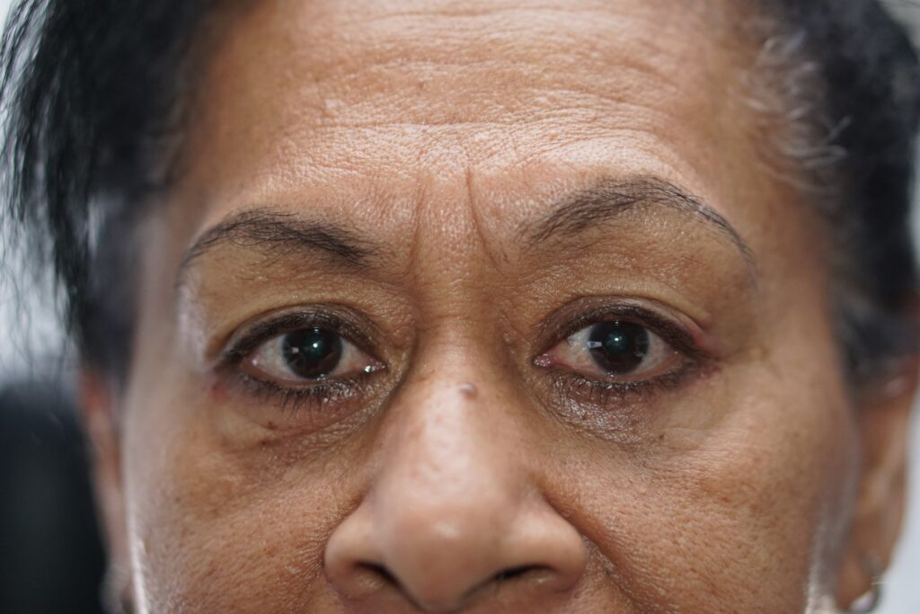 Lower Eyelid Surgery — after