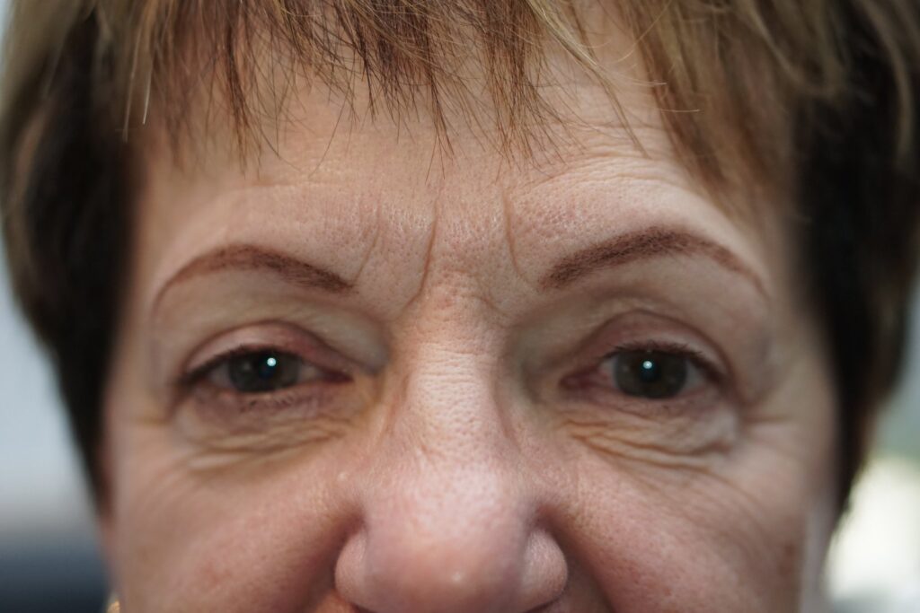 Upper Eyelid Surgery — after