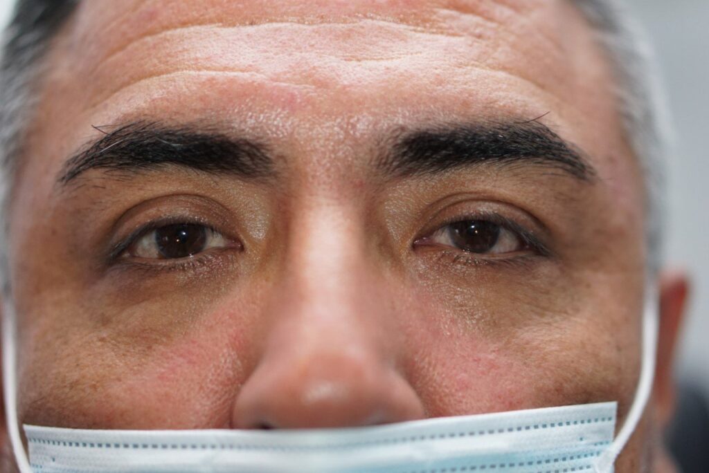 Lower Eyelid Surgery — after
