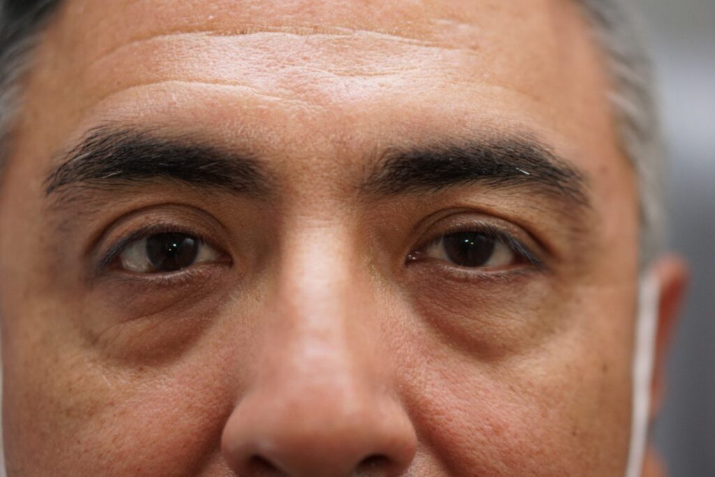 Lower Eyelid Surgery — before