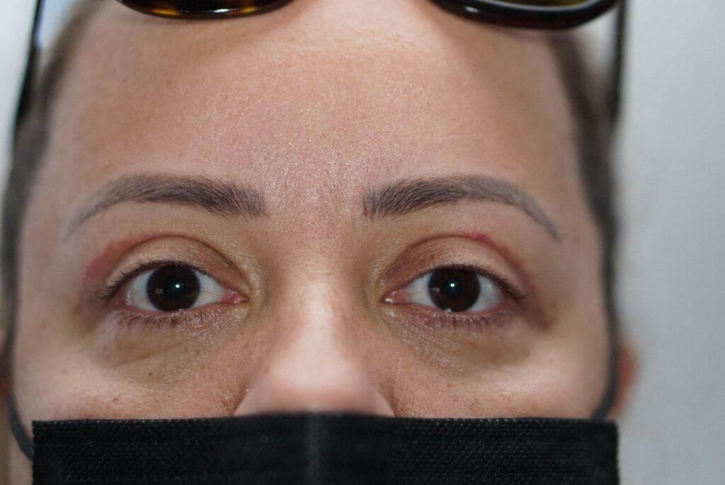 Upper Eyelid Surgery — after