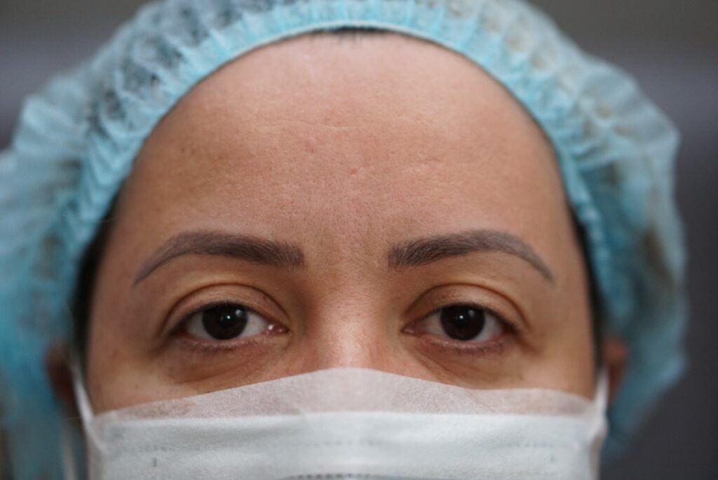 Upper Eyelid Surgery — before