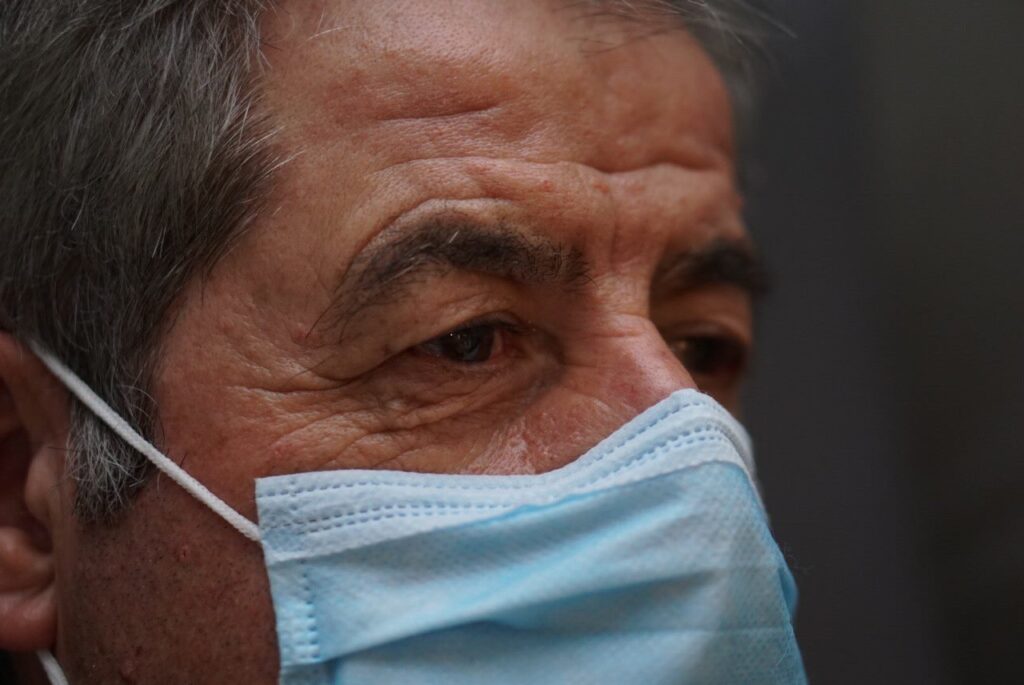 Upper Eyelid Surgery — after