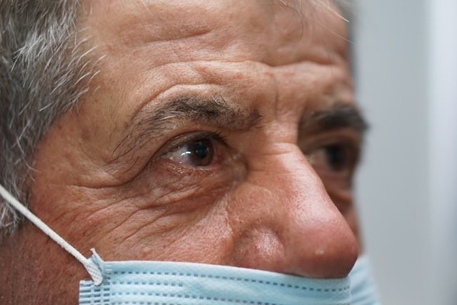 Upper Eyelid Surgery — before