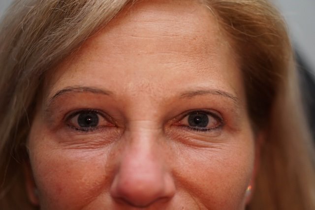 Upper Eyelid Surgery — after
