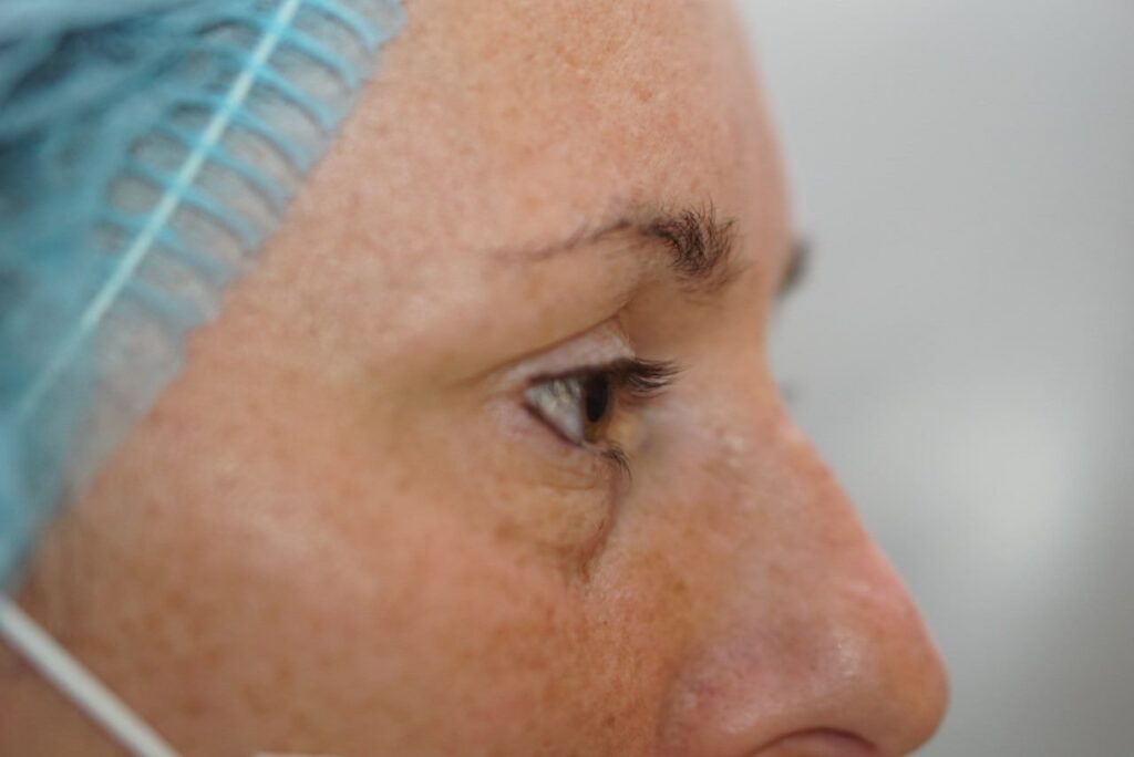 Lower Eyelid Surgery — before