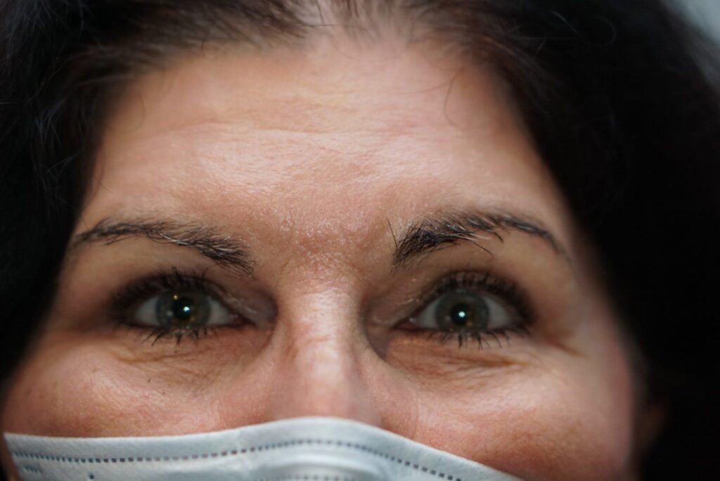Upper Eyelid Surgery — after