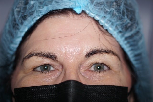 Upper Eyelid Surgery — before