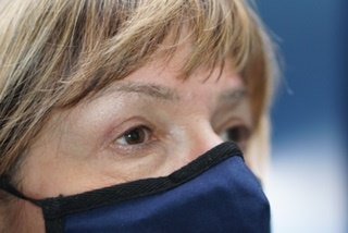 Upper Eyelid Surgery — after