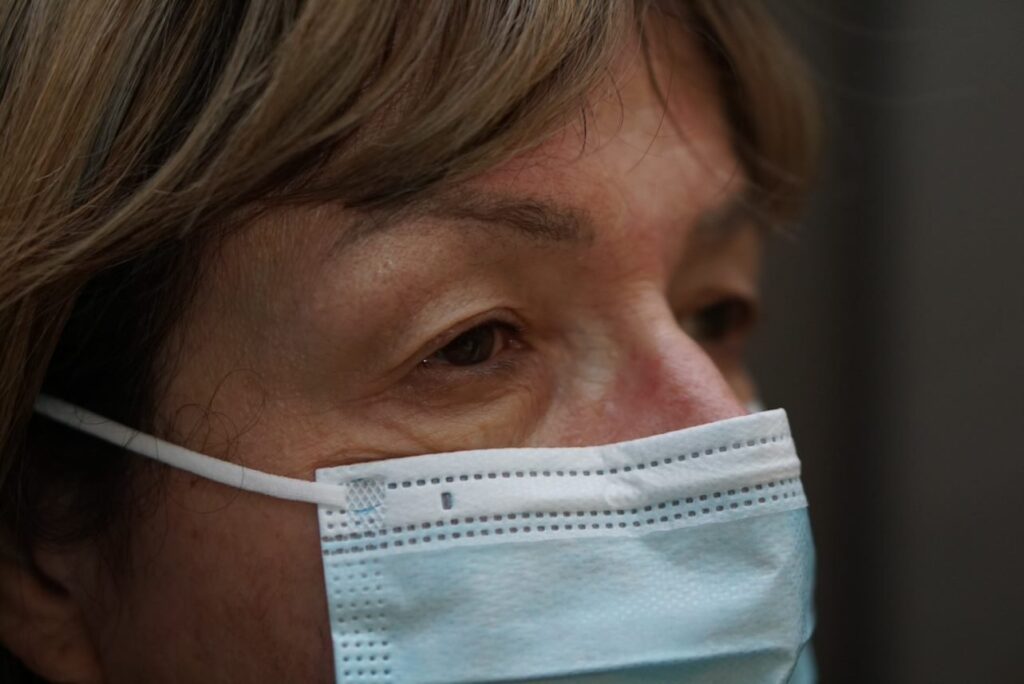 Upper Eyelid Surgery — before