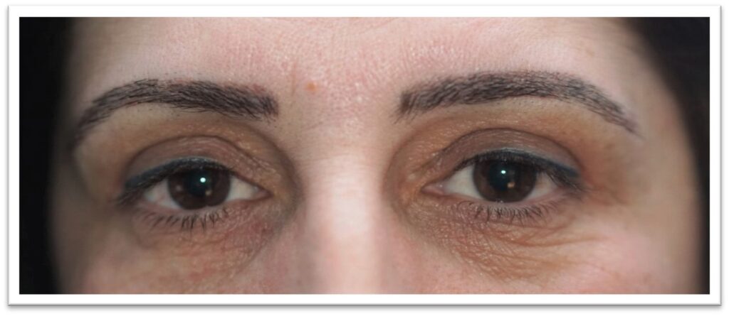 Upper Eyelid Surgery — after