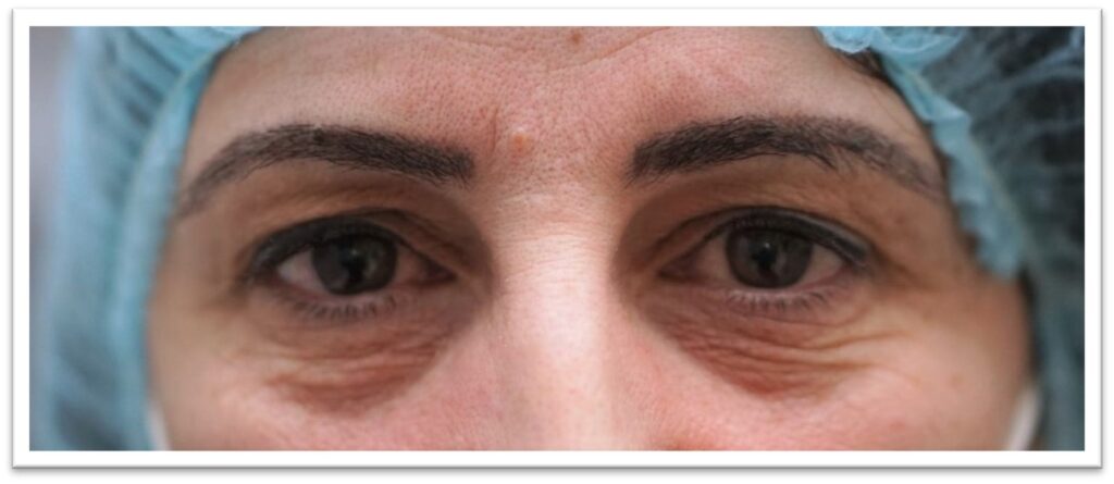 Upper Eyelid Surgery — before