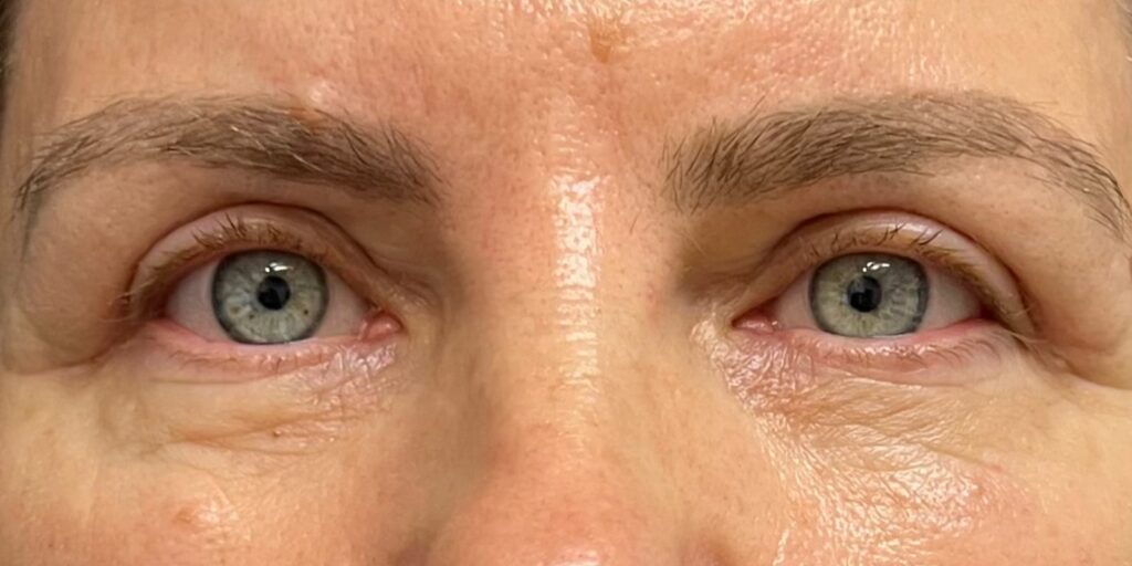 Upper Eyelid Surgery — after