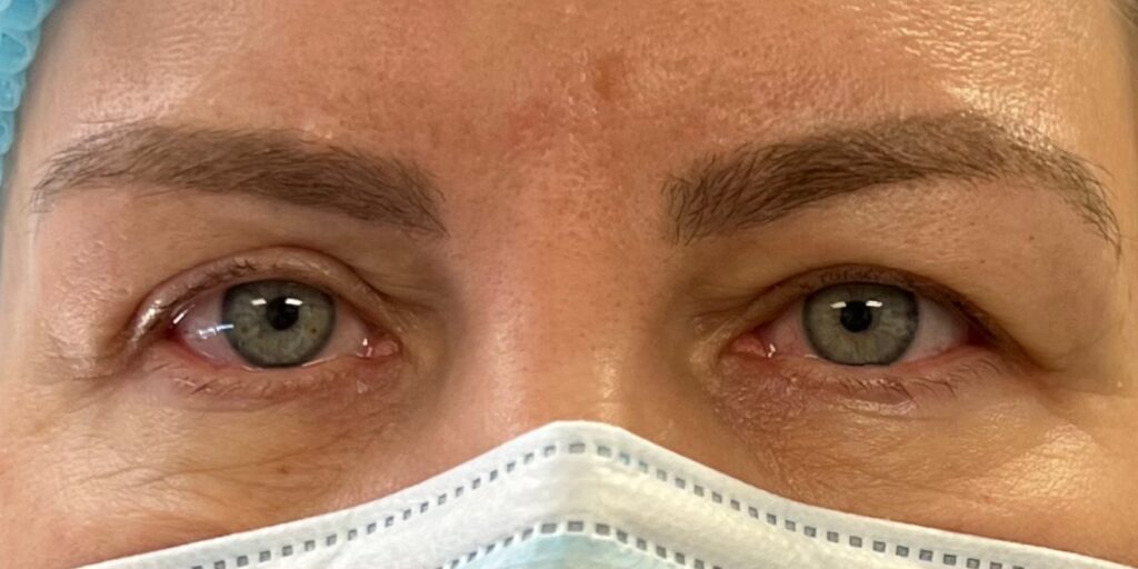 Upper Eyelid Surgery — before