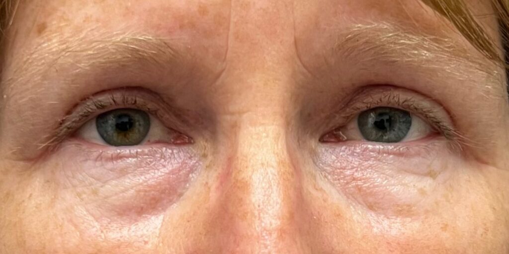 Upper Eyelid Surgery — after