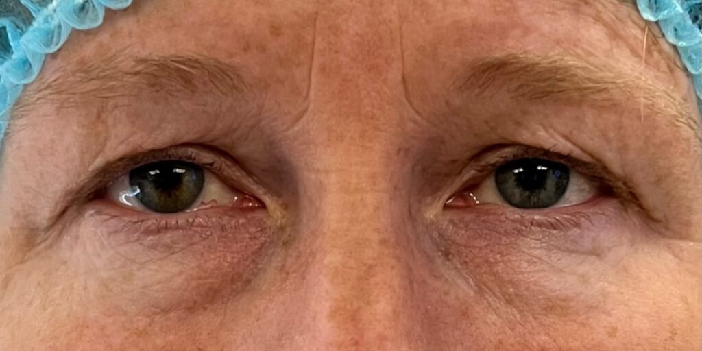 Upper Eyelid Surgery — before
