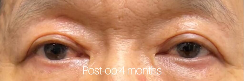 Upper Eyelid Surgery — after