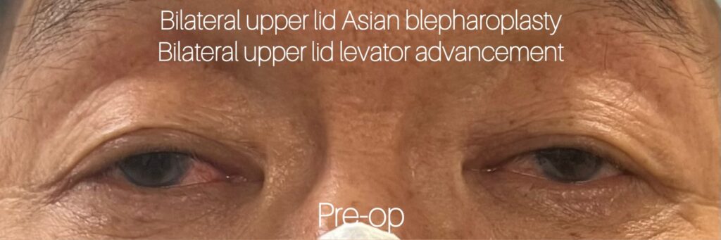 Upper Eyelid Surgery — before