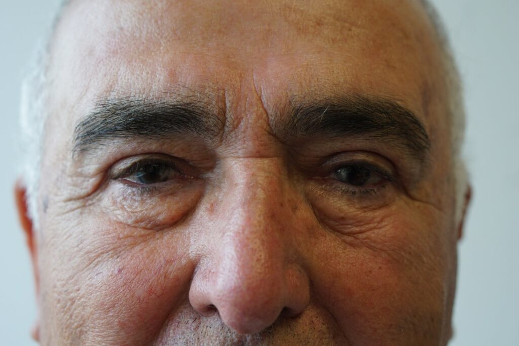 Upper Eyelid Surgery — after