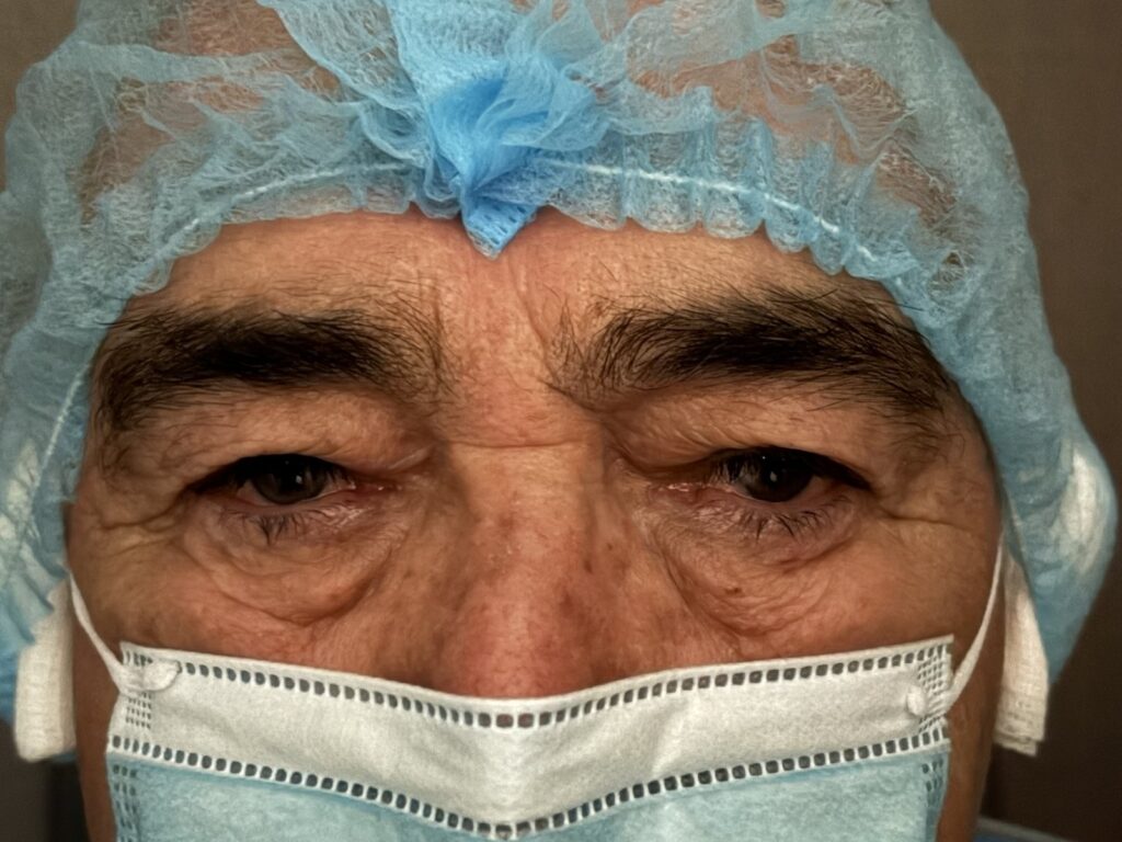 Upper Eyelid Surgery — before