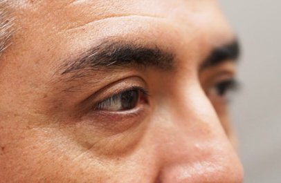 Brow Pexy — before